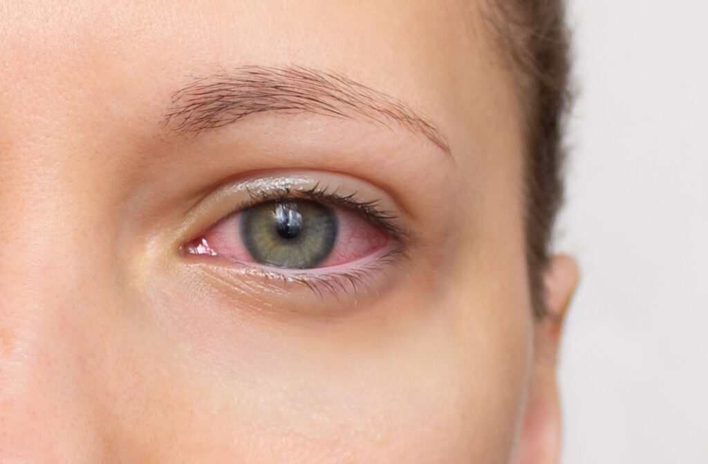 Close-up of woman's face with red eye. Swollen eyelids, irritation, and itching of eyes caused by dry eye syndrome.