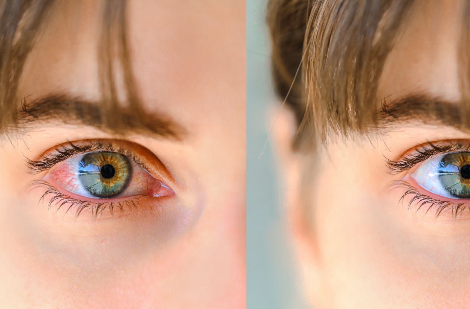 A closeup comparison of dry, red eyes before and after IPL treatment. The left eye is red and the right eye is clear suggesting comfort and hydration.
