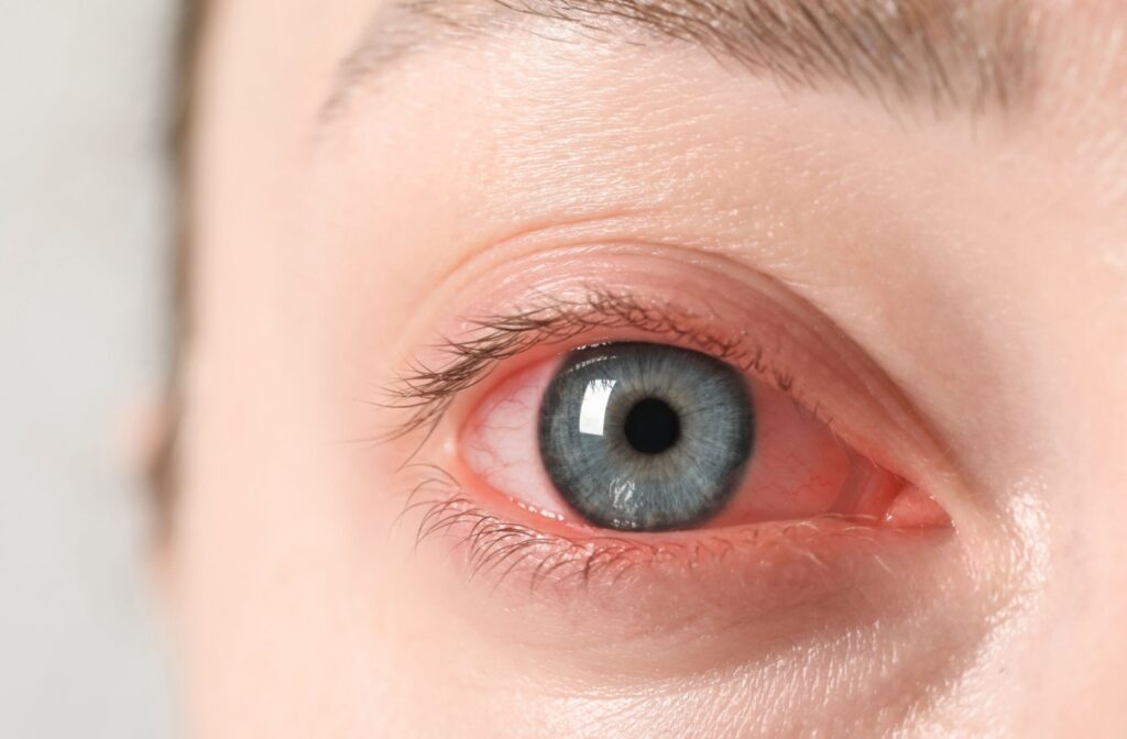 A close-up image of a woman's red irritated eye.