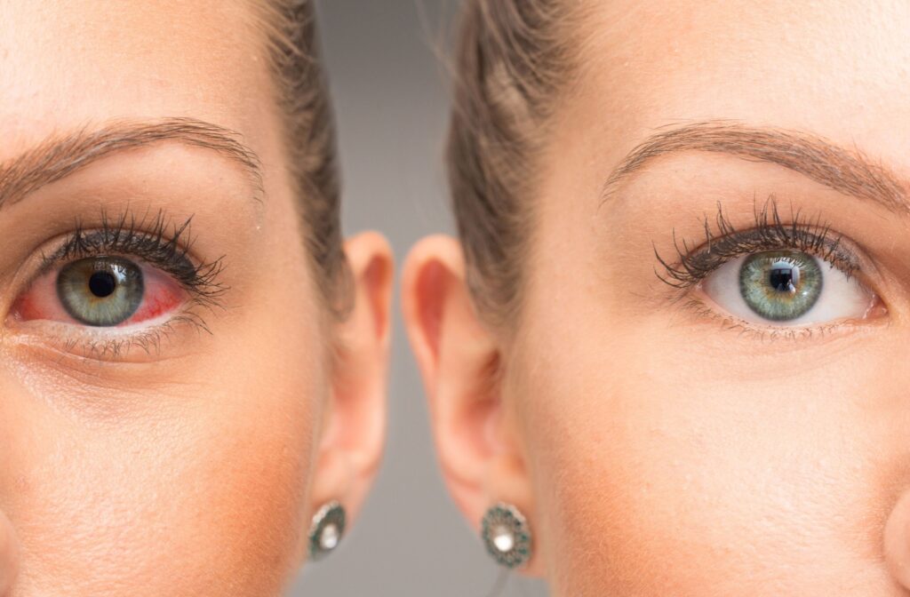 A red eye before and after treatment, the eye on the left is red and irritated, the eye on the right is clear and hydrated.
