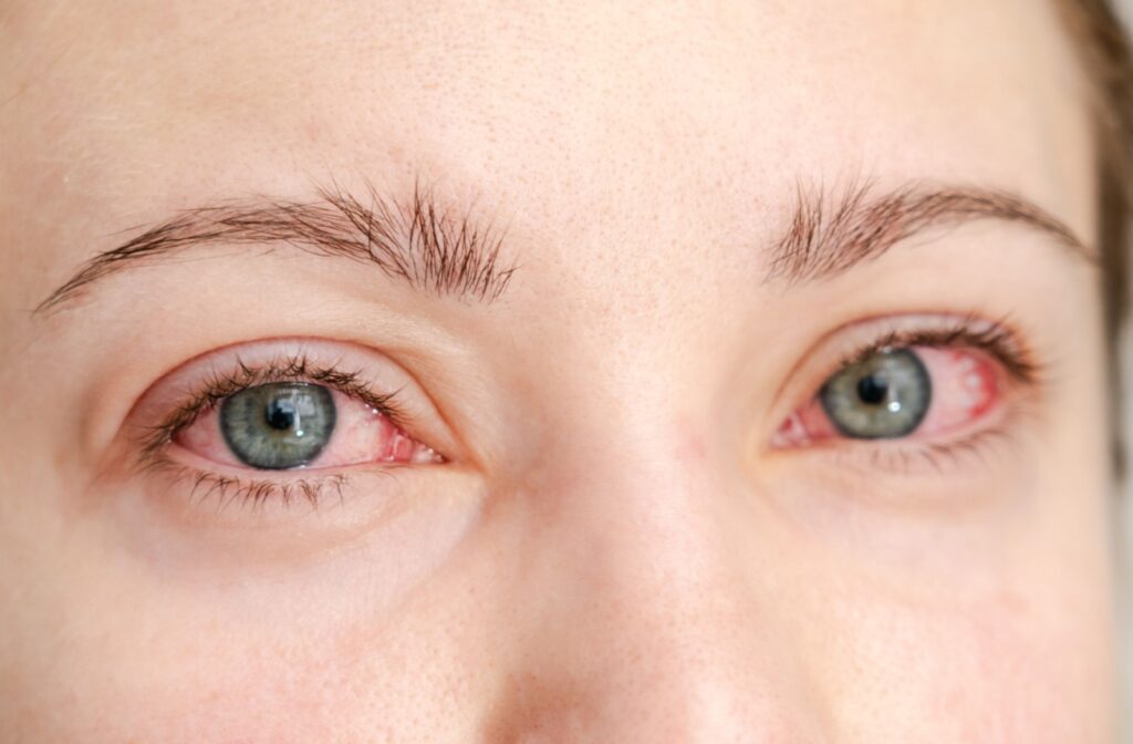 Close-up of a woman with ocular rosacea, showing redness and irritation in both eyes.