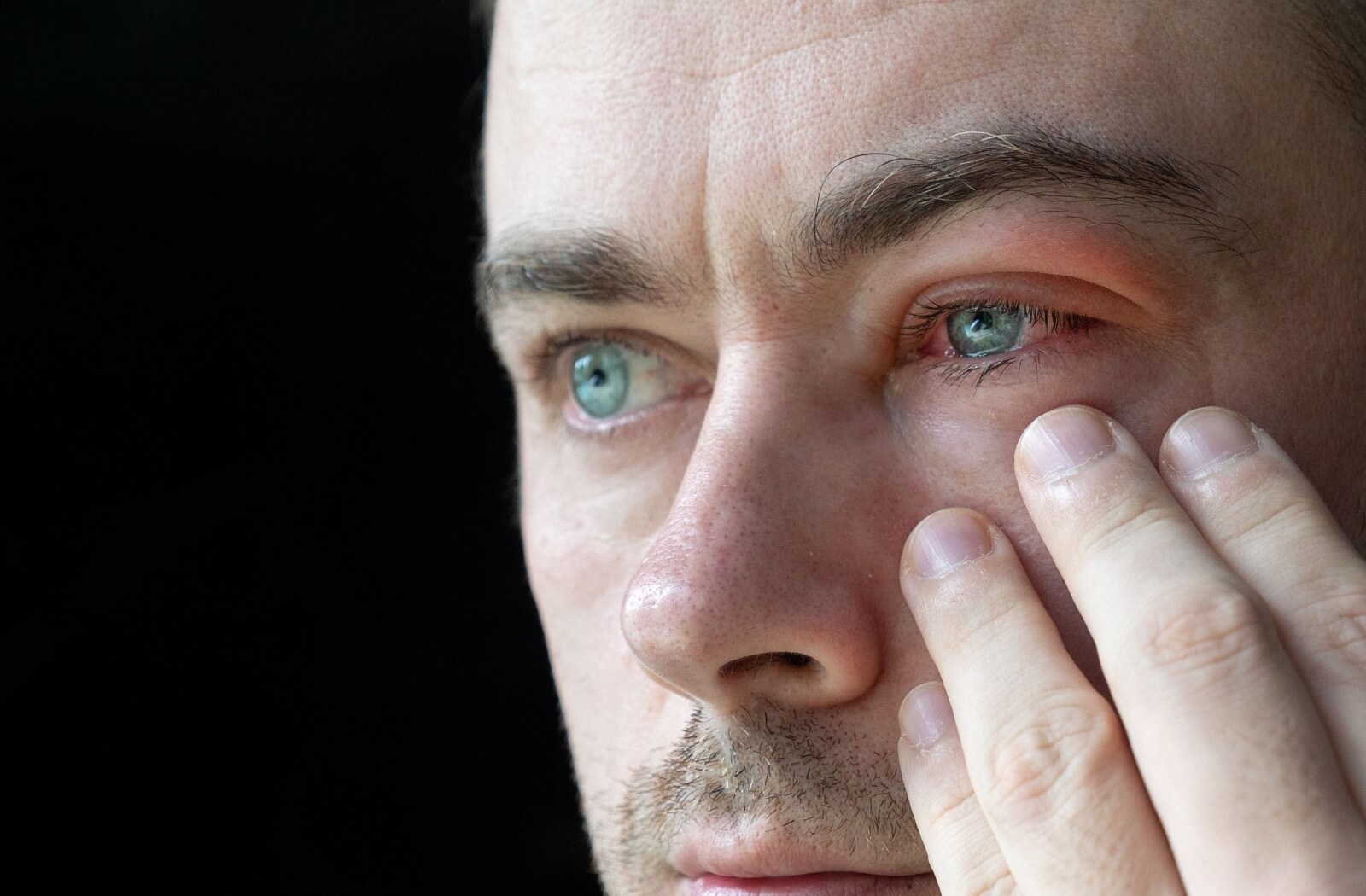 A man with ocular rosacea, showing redness and inflammation around his eye as he touches the affected area.